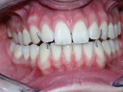 Rimavecplaque neicit - Eugenol