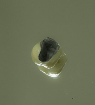 Radicular amputation 1  3  if5b7t - Eugenol