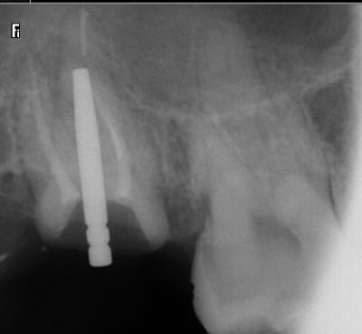 Radio post op osqai8 - Eugenol