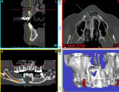 Simplant pi7mpp - Eugenol