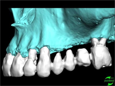 Simullation implantaire assist e par ordinateur positdental 007 xksxm7 - Eugenol