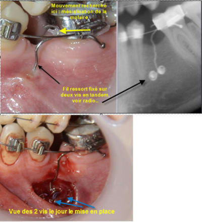 Solene   vis en tandem alb3ia - Eugenol