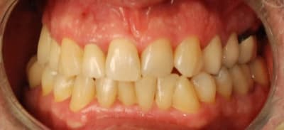 Tri lux 3m2c 3 semaines apr s pose face  2  mybljh - Eugenol