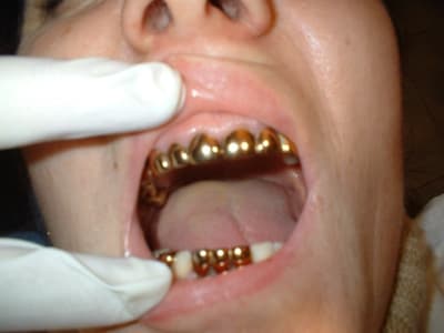Un sourire en or bgkcjb - Eugenol