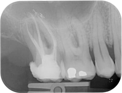 Waveone17post fcxjf1 - Eugenol