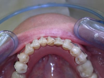  1 mois  1  bis howngn - Eugenol