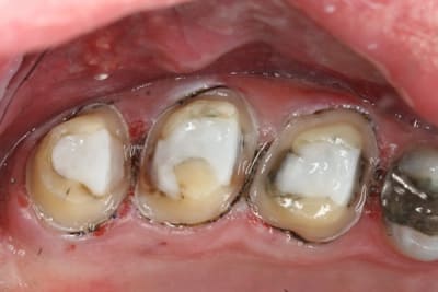  tape 2 b1dmed - Eugenol