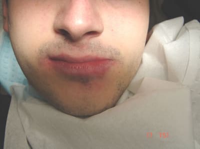 Ac1 axudnd - Eugenol