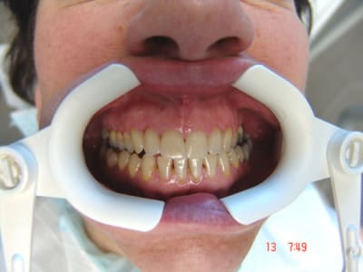 Acro1 fluxs4 - Eugenol