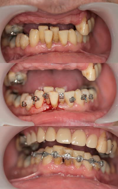 Alignement contention 2 msl034 - Eugenol