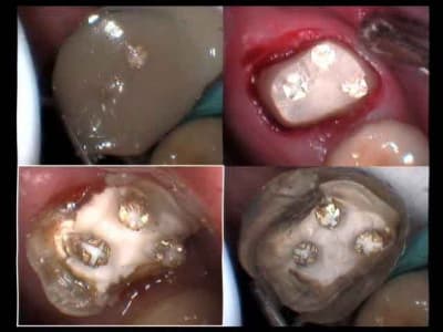 Ancrages  reconstruction  taille sommaire  mojx2c - Eugenol