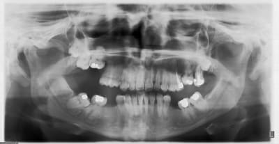 Ankylose ldduiv - Eugenol