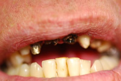 Anterieure prepas post depose od3mqu - Eugenol