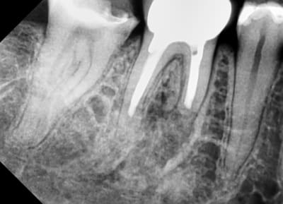 Apicectomy 6 mth dainf3 - Eugenol