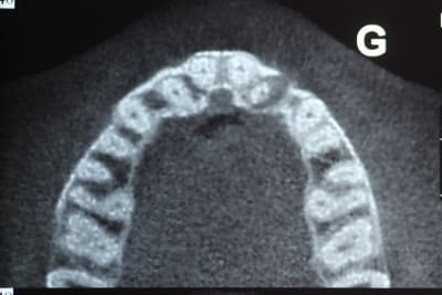 Axial apical phlzsu - Eugenol