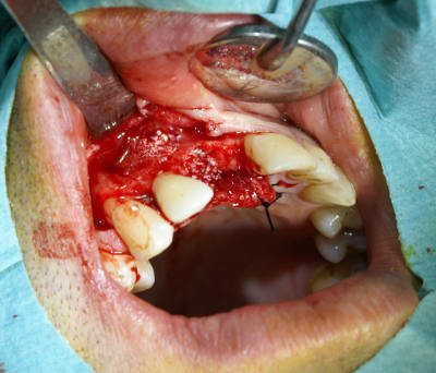 Bio oss apr s forage alv ole nsthmu - Eugenol