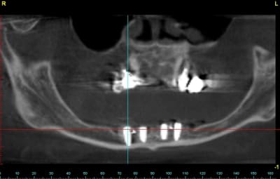 Bo panoramic vhh2vh - Eugenol