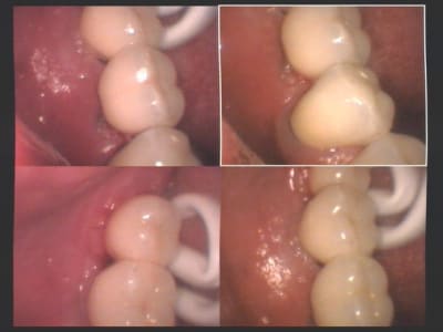 Bridge céramique sur zircone dense scellé sur implants 37  36 et 35 ai98vg - Eugenol