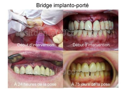 Bridge implanto port  03 du9rv3 - Eugenol