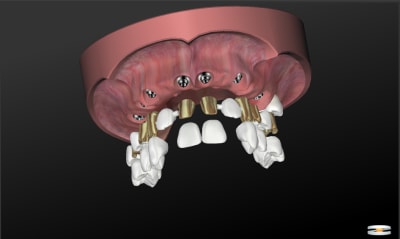 Bridge transvissé ukg3rl - Eugenol