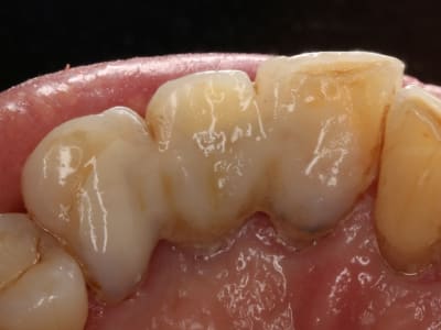 Bridge vectris 2 gbmst8 - Eugenol