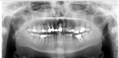 Calculs eczzux - Eugenol