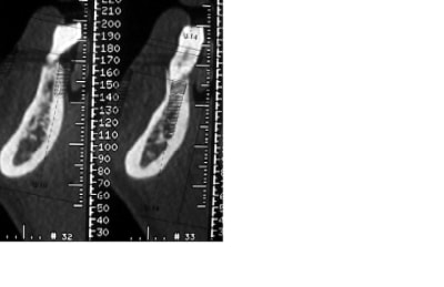 Canal incisif 2 uk2z2v - Eugenol