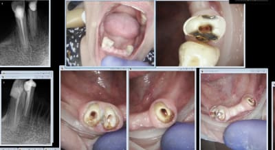 Cap d 4 dx7emg - Eugenol