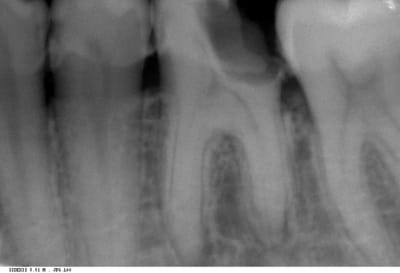 Carie prox fo6yrw - Eugenol