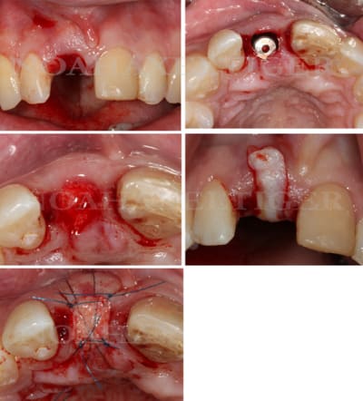 Cas clinique gqtvsz - Eugenol