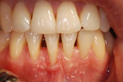 Cas de greffe z2prwq - Eugenol