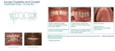 Case2before hbix9l - Eugenol