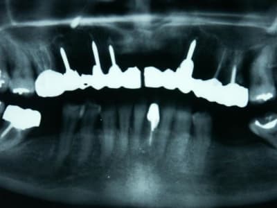 Casto implant dwdzps - Eugenol