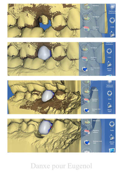 Cerec 3 zdcfrw - Eugenol