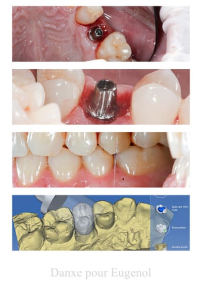 Cerec 5 d3gu0w - Eugenol