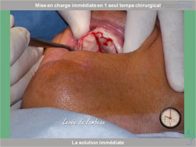 Chirurgie guidée mise en charge immédiate 0005 wnerrk - Eugenol