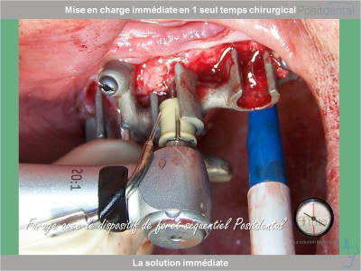 Chirurgie guidée mise en charge immédiate 0009 nvsimy - Eugenol