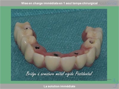 Chirurgie guidée mise en charge immédiate 0026 gexfqk - Eugenol