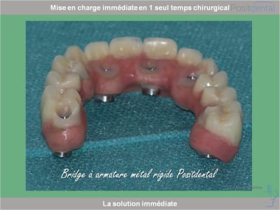 Chirurgie guidée mise en charge immédiate 0027 awi9bt - Eugenol