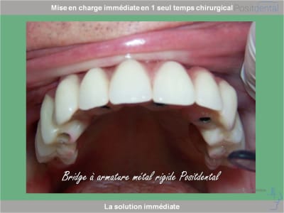 Chirurgie guidée mise en charge immédiate 0029 g5cekm - Eugenol