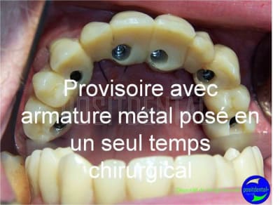 Cicatrisation gingivale suite eimci positdental 5 bmawza - Eugenol