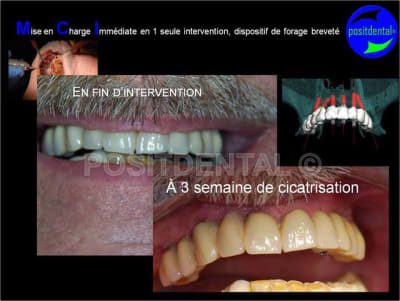 Cicatrisation gingivale suite mci positdental 2 xycntl - Eugenol