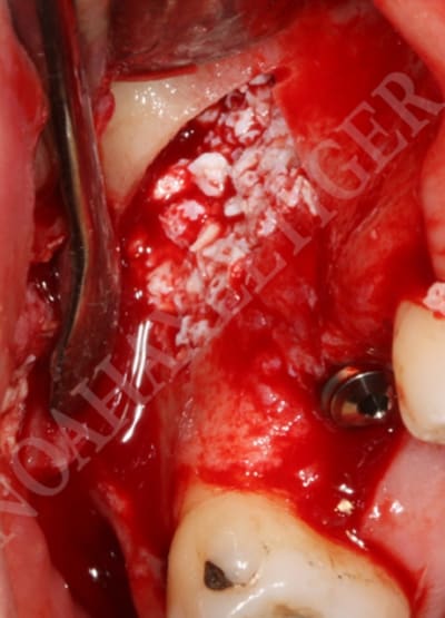 Comblement repu2y - Eugenol