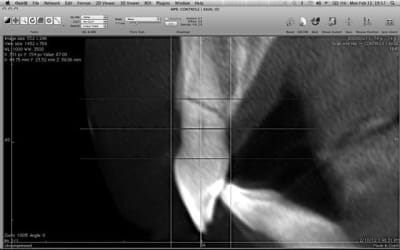 Cone beam fracture iw5sgg - Eugenol