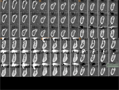Coupe scanner extraction implantation 2 j6hj8m - Eugenol