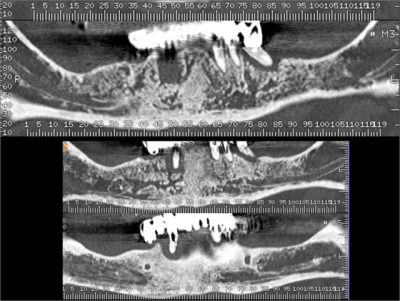 Coupe scanner extraction implantation gvpad3 - Eugenol
