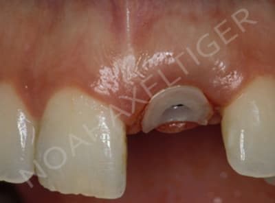 Customized healing abutment c8863q - Eugenol
