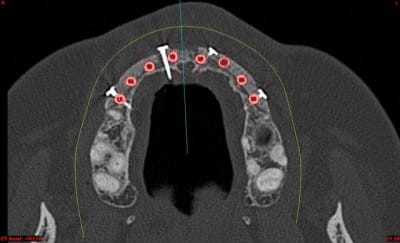 Dar axiali qui1is - Eugenol