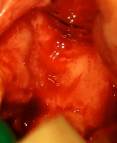 Defaut ant suraun - Eugenol