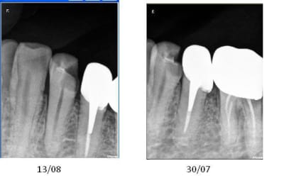 Dent abces fdicbl - Eugenol